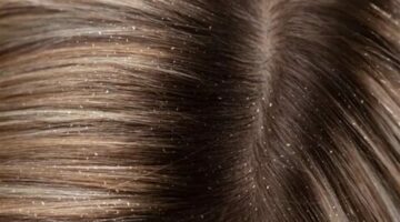3 وصفات طبيعية للتخلص من قشرة الشعر بشكل نهائي بمكونات بسيطة موجودة في كل بيت.. انسي القلق والتوتر