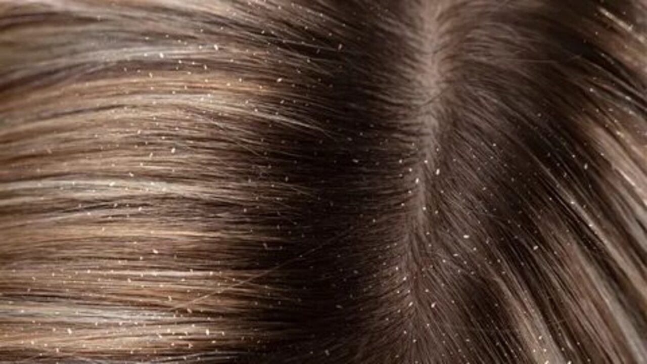 3 وصفات طبيعية للتخلص من قشرة الشعر بشكل نهائي بمكونات بسيطة موجودة في كل بيت.. انسي القلق والتوتر