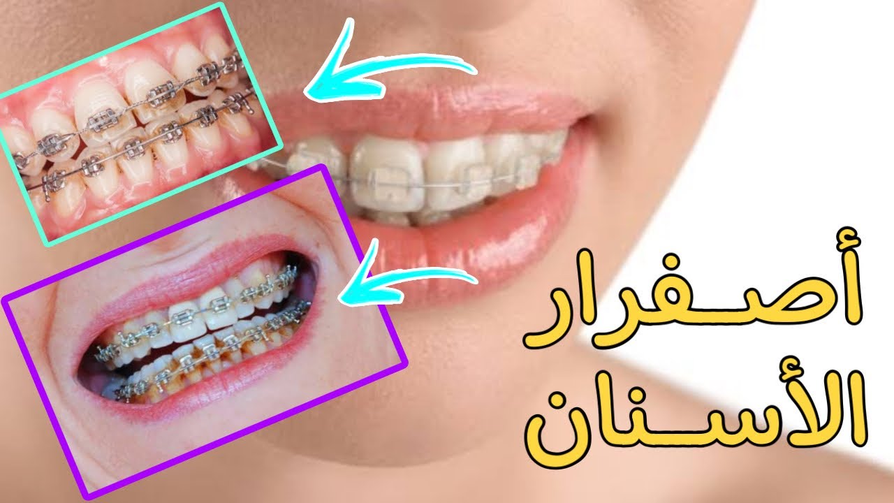 أسباب اصفرار الأسنان وطرق التخلص من الإصفرار