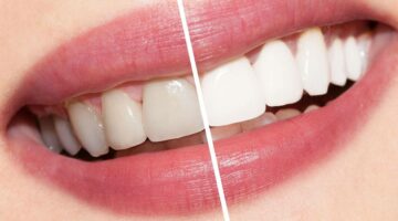 طرق تبييض الاسنان في البيت بسرعة وبمكونات متوفرة وغير مكلفة